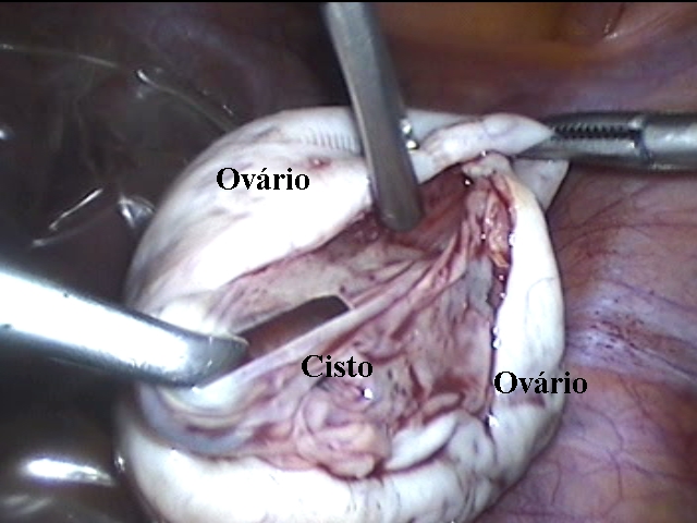 Arquivos Cistos de Ovários - Scope Ginecologia